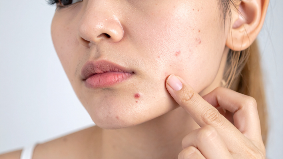 Best Exfoliants for Acne-Prone Skin