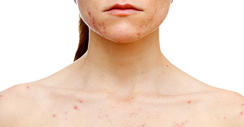 Breakout or Skin Purging? How to tell the difference.