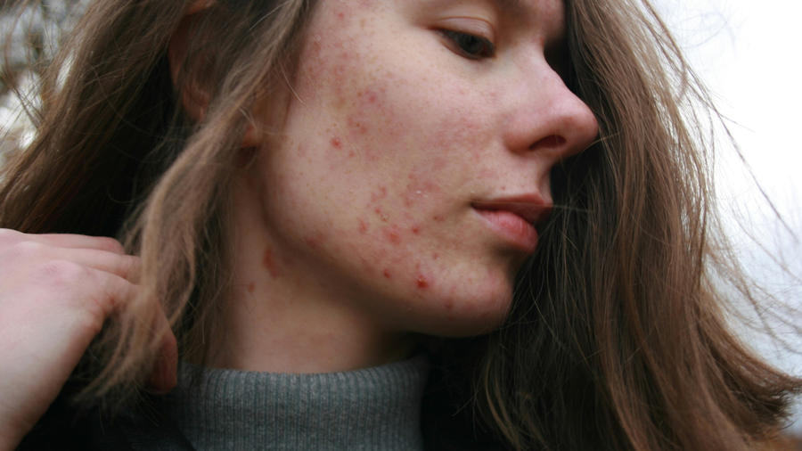 Young woman with severe acne on her face and neck