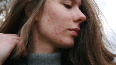 Does Vitamin C Help Acne & Acne Scars? Here’s What Experts Say