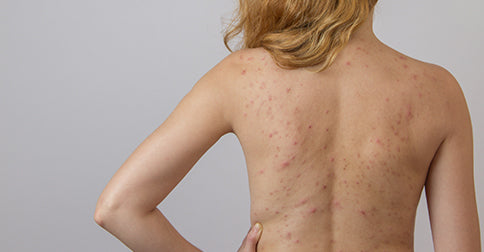 Chest Acne, Back Acne, and More: How to Get Rid of Body Acne