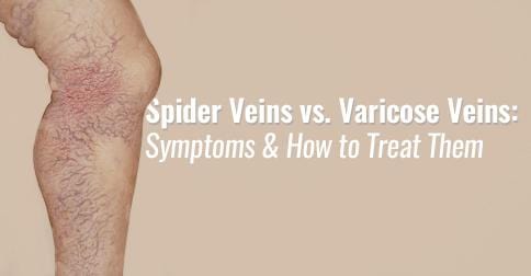 Spider Veins vs. Varicose Veins: Symptoms and How to Treat Them