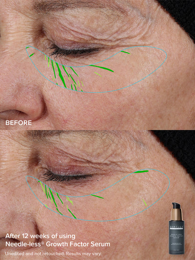 The Needle-less® Duo