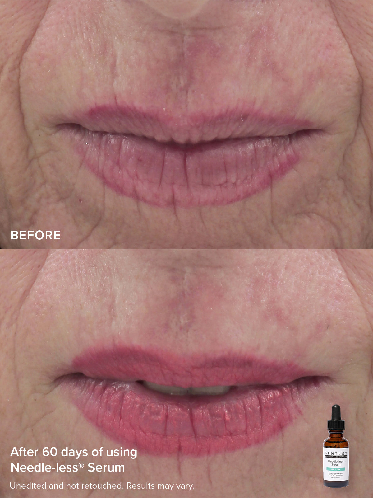 The Needle-less® Duo