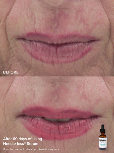 The Needle-less® Duo