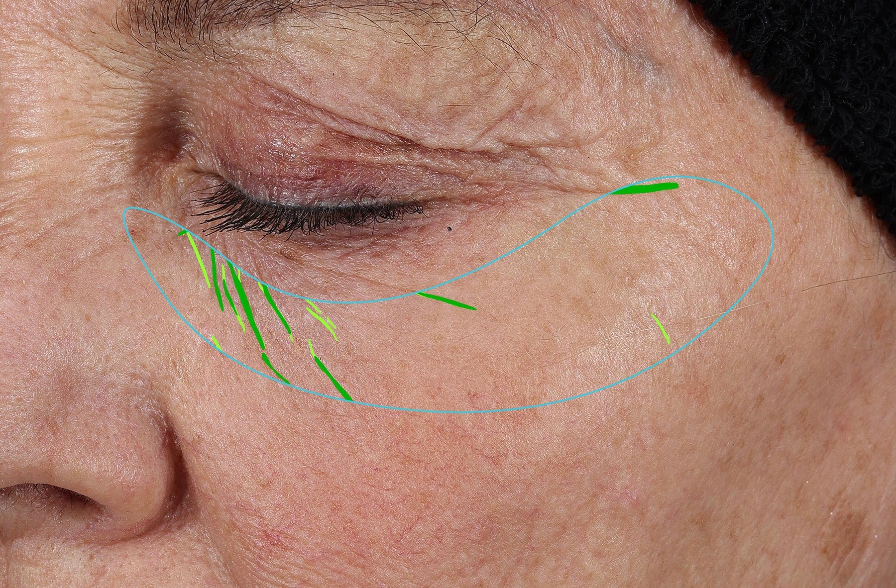 Needle-less® Growth Factor Serum