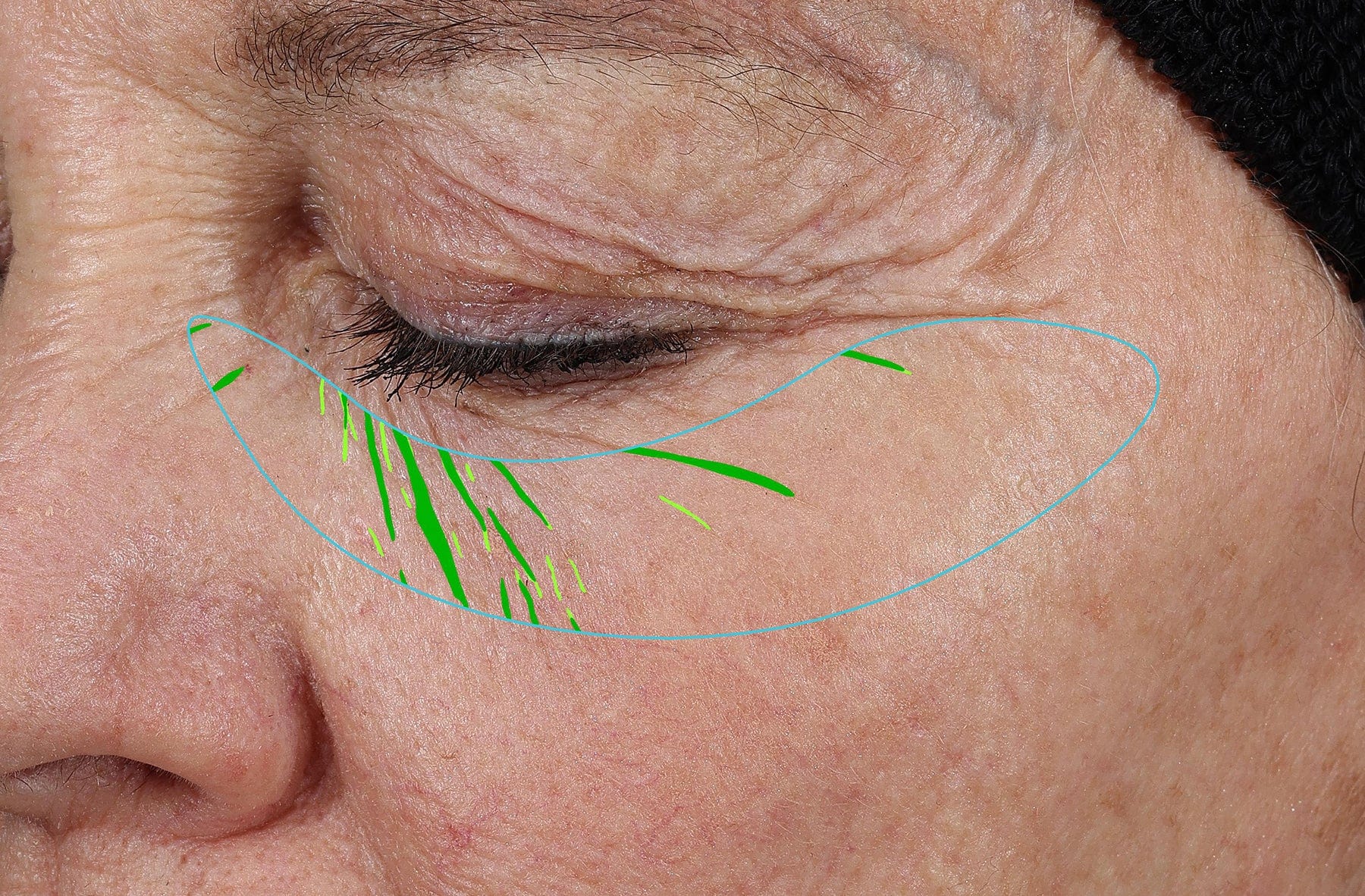 Needle-less® Growth Factor Serum